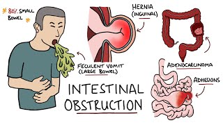 Intestinal Obstruction  Small Bowel Obstruction vs Large Bowel Obstruction [upl. by Unders]