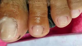 Toenail Ingrown Removal sa dami [upl. by Glassman]