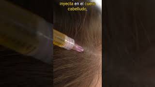 ¿Caída del cabello tu propia sangre puede ser la clave para recuperarlo esteticavicentelopez [upl. by Richlad]