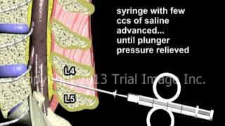 Epidural Spinal Anesthesia  Animation by Dr Cal Shipley MD [upl. by Nawiat600]