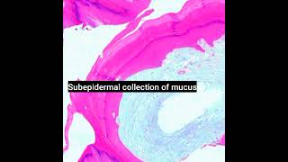 Histopathology of Digital Mucus Cyst dermpath dermatopathology shorts [upl. by Flo]