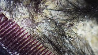 Dandruff scratching removal on head using black combing357 [upl. by Annoel154]