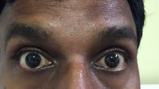 Parinauds syndrome with restricted upgaze eyelid retraction amp convergence retraction nystagmus [upl. by Anawit]