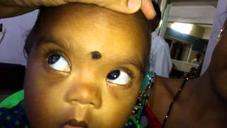 CHILDHOOD BLINDNESS  CATARACT [upl. by Malissia]