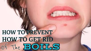 How to Prevent and to Cure Boils [upl. by Dnalevelc165]