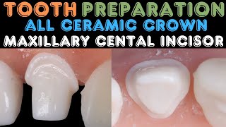 Tooth Preparation Maxillary Central Incisor ⚪️All Ceramic Crown🔵 Precident Crown Preparation Kit Pro [upl. by Julita593]