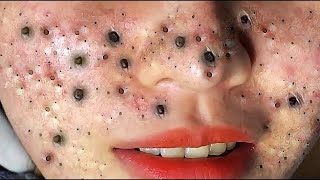 Big Cystic Acne Blackheads Extraction Blackheads amp Milia Whiteheads Removal Pimple Popping  614 [upl. by Oicirbaf713]