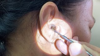 Massive Hard Dry Earwax Removed from Womans Ear [upl. by Amirak]