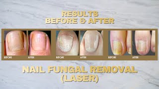 Fungal Nail Treatment  Fotona Laser [upl. by Cirillo492]