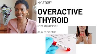 My Story  Overactive Thyroid  Hyperthyroidism  Graves Disease [upl. by Campball]