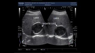 Ultrasound Video showing Hepatic Hydatid Cyst and Uterine Hemangioma Two Videos [upl. by Sosthenna]