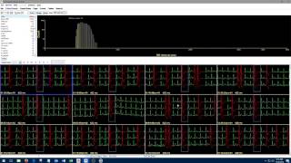 1 Introduction to Holter Analysis NEM [upl. by Laehcim]