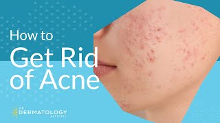 Acne Treatment  Explained by Dermatologist [upl. by Torrey]