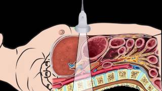 Introduction Abdominal Aorta Focused Ultrasound Examination [upl. by Early]