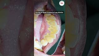 Is dental scaling harmful dentalscaling toothcleaning [upl. by Acsirp971]