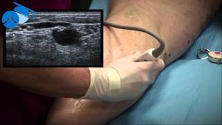 Marking of Small Saphenous Vein SSV and Incompetent Perforating Vein IPV [upl. by Otina]