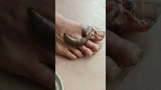 LEECH THERAPY IN DIABETIC ULCER REWAAYURVEDA [upl. by Htelimay]