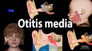 Otitis Media Anatomy Pathophysiology Risk Factors Types of OM Symptoms and Treatment Animation [upl. by Eivol]