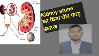 kidney stone treatment kidneystone kidneycare kidneydisease [upl. by Gilba]