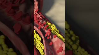 Heart Blockage💥 Angioplasty Explained in 30 Seconds ⏰quot [upl. by Dunaville]