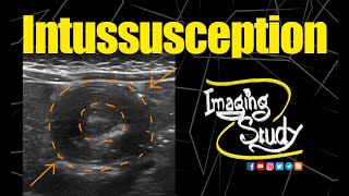 Intussusception  Ultrasound  Case 154 [upl. by Babbie554]