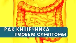 Симптомы рака кишечника Как проявляются первые симптомы рака кишечника Колопроктология [upl. by Scherle424]