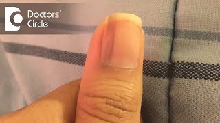 What causes vertical black lines on fingernails  Dr Aruna Prasad [upl. by Rhianna455]