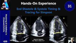 End Diastole amp Systole Timing amp Tracing for Simpson handson Experience 31 [upl. by Bull]