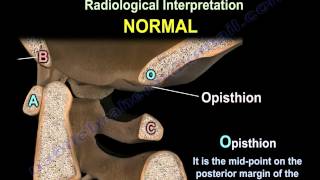 Occipitocervical Dislocation  Everything You Need To Know  Dr Nabil Ebraheim [upl. by Ixela]