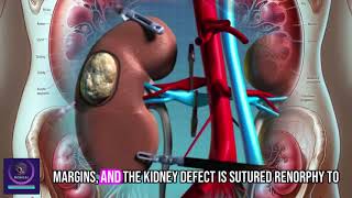 Minimally Invasive Kidney Surgery  Medical Animation Video [upl. by Lang]