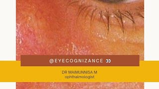 What is Dacryocystitis eyecognizance [upl. by Friede947]