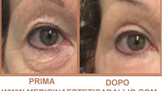 Blefaroplastica non chirurgica con Laser frazionato associato a PRP  Drssa Ballio [upl. by Notlok]