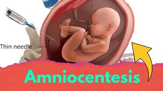 Amniocentesis class 12 biology  Amniocentesis test [upl. by Iila]