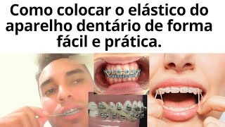 Como colocar os elásticos do aparelho dentário de forma fácil e prática [upl. by Rj335]