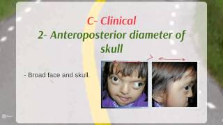 Crouzon syndrome  Definition  Etiology  Clinical [upl. by Eilitan]