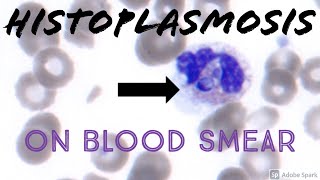 Intracellular YeastFungus on Peripheral Blood Smear Histoplasmosis Hematology Microbiology [upl. by Jadwiga378]