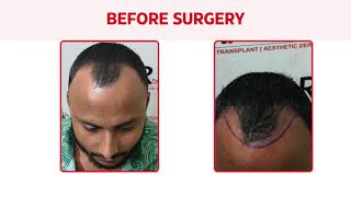 Revitalize Your Hair with Expert Hair Transplant PRP amp GFC  Hair Destination [upl. by Deirdra393]