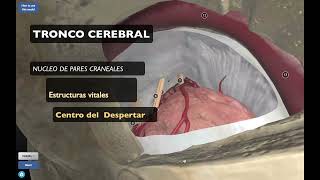 Cavernoma de Tronco cerebral [upl. by Anelys]