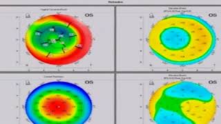 AIOC2018  GP066  Topic  Aberrometry and how it helps in diagnostics [upl. by Salinas]