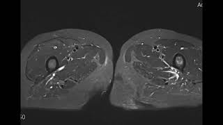 Impending intertrochanter fracutre proxfemur Lt [upl. by Randa]