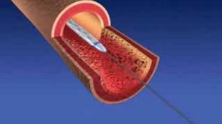 Balloon Angioplasty and Stent Implantaion [upl. by Nylynnej]