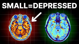 Not Growing Your Brain Makes You Depressed [upl. by Nosimaj265]