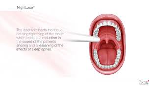 Snoring and Sleep Apnea Treatment with NightLase® [upl. by Naharba]