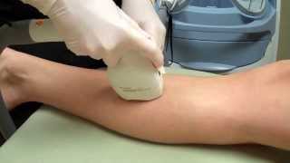 LightSheer Duet Laser Hair Removal on a Womans Legs [upl. by Nyliret]