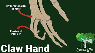 Claw hand deformity Ulnar nerve palsy [upl. by Ahsimik934]