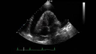 2 D ECHO  MASSIVE PERICARDIAL EFFUSION [upl. by Eusassilem]