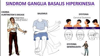 Video 53 Sindrom Ganglia Basalis Hiperkinesia [upl. by Vivian]