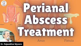 Perianal Abscess Treatment  Dr Rajasekhar Mysore  Chirag Global Hospitals [upl. by Melinda]