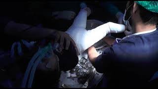 Technique of Hip Spica  Dr Abdul Latif Shahid  Pediatric Orthopedic Surgeon [upl. by Thoer917]