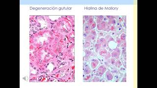 Patología 5 Acumulaciones Intracelulares [upl. by Llenej]